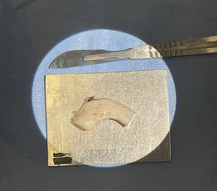 Rinoplastia com Cartilagem de Costela